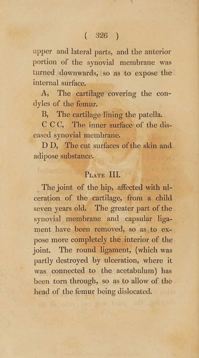 ( 326 ) upper and lateral parts, and the anterior portion of the synovial membrane was turned downwards, so as to expose the internal surface. _ A, The cartilage covering the con- dyles of the femur. B, The cartilage lining the patella. C CC,. The inner surface: of the dis- eased synovial membrane. DD, The cut surfaces of the skin and adipose substance. ee IIl. Ee The joint of the hip, affected wath ul- ceration of the cartilage, from a child seven years old. - The greater part of the synovial membrane and. capsular liga- ment have been. removed, so as,to ex- pose more completely the interior of the joint. The round ligament, (which was partly destroyed by ulceration, where it was connected to the acetabulum) has been torn through, so as to allow of the head of the femur being dislocated.