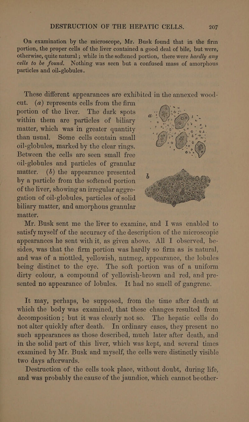 On examination by the microscope, Mr. Busk found that in the firm portion, the proper cells of the liver contained a good deal of bile, but were, otherwise, quite natural ; while in the softened portion, there were hardly any cells to be found. Nothing was seen but a confused mass of amorphous particles and oil-globules. | These different appearances are exhibited in the annexed wood- cut. (a) represents cells from the firm portion of the liver. The dark spots within them are particles of biliary matter, which was in greater quantity than usual. Some cells contain small oil-globules, marked by the clear rings. Between the cells are seen small free oil-globules and particles of granular matter. (%) the appearance presented by a particle from the softened portion of the liver, showing an irregular aggre- gation of oil-globules, particles of solid biliary matter, and amorphous granular matter. Mr. Busk sent me the liver to examine, and I was enabled to satisfy myself of the accuracy of the description of the microscopic appearances he sent with it, as given above. All I observed, be- sides, was that the firm portion was hardly so firm as is natural, and was of a mottled, yellowish, nutmeg, appearance, the lobules being distinct to the eye. The soft portion was of a uniform dirty colour, a compound of yellowish-brown and red, and pre- sented no appearance of lobules. It had no smell of gangrene. It may, perhaps, be supposed, from the time after death at which the body was examined, that these changes resulted from decomposition ; but it was clearly not so. The hepatic cells do not alter quickly after death. In ordinary cases, they present no such appearances as those described, much later after death, and in the solid part of this liver, which was kept, and several times examined by Mr. Busk and myself, the cells were distinctly visible two days afterwards. Destruction of the cells took place, without doubt, during life, and was probably the cause of the jaundice, which cannot be other-