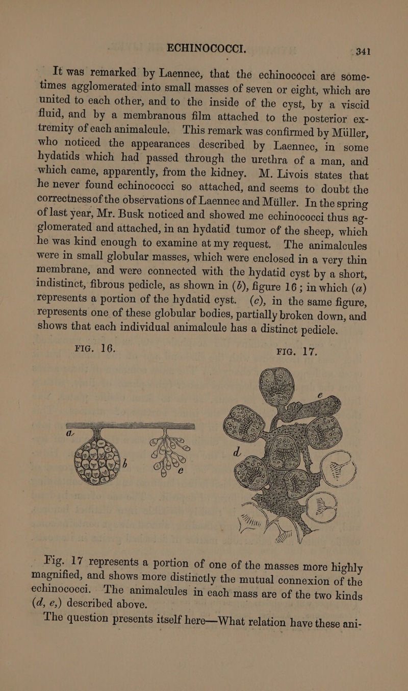 It was remarked by Laennec, that the echinococci aré some- times agglomerated into small masses of seven or eight, which are united to each other, and to the inside of the cyst, by a viscid fluid, and by a membranous film attached to the posterior ex- tremity ofeach animalcule, This remark was confirmed by Muller, who noticed the appearances described by Laennec, in some hydatids which had passed through the urethra of a man, and which came, apparently, from the kidney. M. Livois states that he never found echinococci so attached, and seems to doubt the correctnessof the observations of Laennec and Miiller. In the spring of last year, Mr. Busk noticed and showed me echinococci thus ag- glomerated and attached, in an hydatid tumor of the sheep, which he was kind enough to examine at my request. The animalcules were in small globular masses, which were enclosed in a very thin membrane, and were connected with the hydatid cyst by a short, indistinct, fibrous pedicle, as shown in (6), figure 16 ; in which (a) represents a portion of the hydatid cyst. (c), in the same figure, represents one of these globular bodies, partially broken down, and shows that each individual animalcule has a distinct pedicle. FIG, 16. : FIG. 17, af = Es ee. LAP - Fig. 17 represents a portion of one of the masses more highly magnified, and shows more distinctly the mutual connexion of the echinococci. The animalcules in cach mass are of the two kinds (d, e,) described above. 7 The question presents itself here—What relation have these ani-