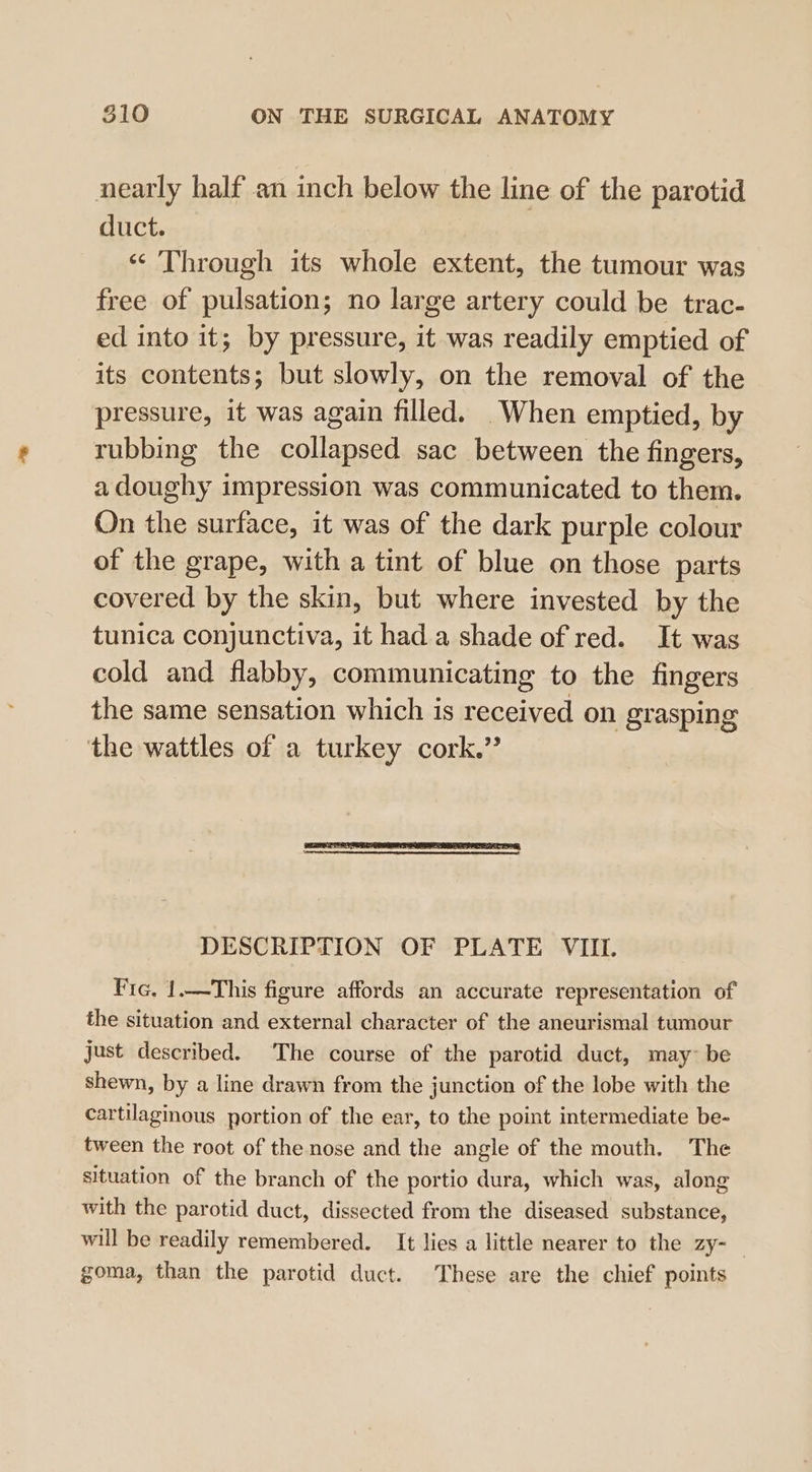 nearly half an inch below the line of the parotid duct. ? ‘Through its whole extent, the tumour was free of pulsation; no large artery could be trac- ed into it; by pressure, it was readily emptied of its contents; but slowly, on the removal of the pressure, it was again filled. When emptied, by rubbing the collapsed sac between the fingers, a doughy impression was communicated to them. On the surface, it was of the dark purple colour of the grape, with a tint of blue on those parts covered by the skin, but where invested by the tunica conjunctiva, it had a shade of red. It was cold and flabby, communicating to the fingers the same sensation which is received on grasping the wattles of a turkey cork.” DESCRIPTION OF PLATE VIII. Fic, 1.—This figure affords an accurate representation of the situation and external character of the aneurismal tumour just described. The course of the parotid duct, may~ be shewn, by a line drawn from the junction of the lobe with the cartilaginous portion of the ear, to the point intermediate be- tween the root of the nose and the angle of the mouth. The situation of the branch of the portio dura, which was, along with the parotid duct, dissected from the diseased substance, will be readily remembered. It lies a little nearer to the zy- _ goma, than the parotid duct. These are the chief points