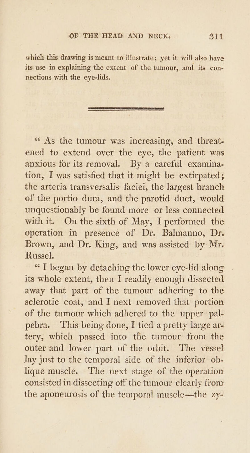 which this drawing is meant to illustrate; yet it will also have its use in explaining the extent of the tumour, and its con- nections with the eye-lids. «¢ As the tumour was increasing, and threat- ened to extend over the eye, the patient was anxious for its removal. By a careful examina- tion, I was satisfied that it might be extirpated; the arteria transversalis faciei, the largest branch of the portio dura, and the parotid duct, would unquestionably be found more or less connected with it. On the sixth of May, I performed the operation in presence of Dr. Balmanno, Dr. Brown, and Dr. King, and was assisted by Mr. Russel. : “‘ I began by detaching the lower eye-lid along its whole extent, then I readily enough dissected away that part of the tumour adhering to the sclerotic coat, and I next removed that portion of the tumour which adhered to the upper pal- pebra. ‘This being done, I tied a pretty large ar- tery, which passed into the tumour from the outer and lower part of the orbit. ‘The vessel Jay just to the temporal side of the inferior ob- lique muscle. ‘The next stage of the operation consisted in dissecting off the tumour clearly from the aponeurosis of the temporal muscle—the zy-