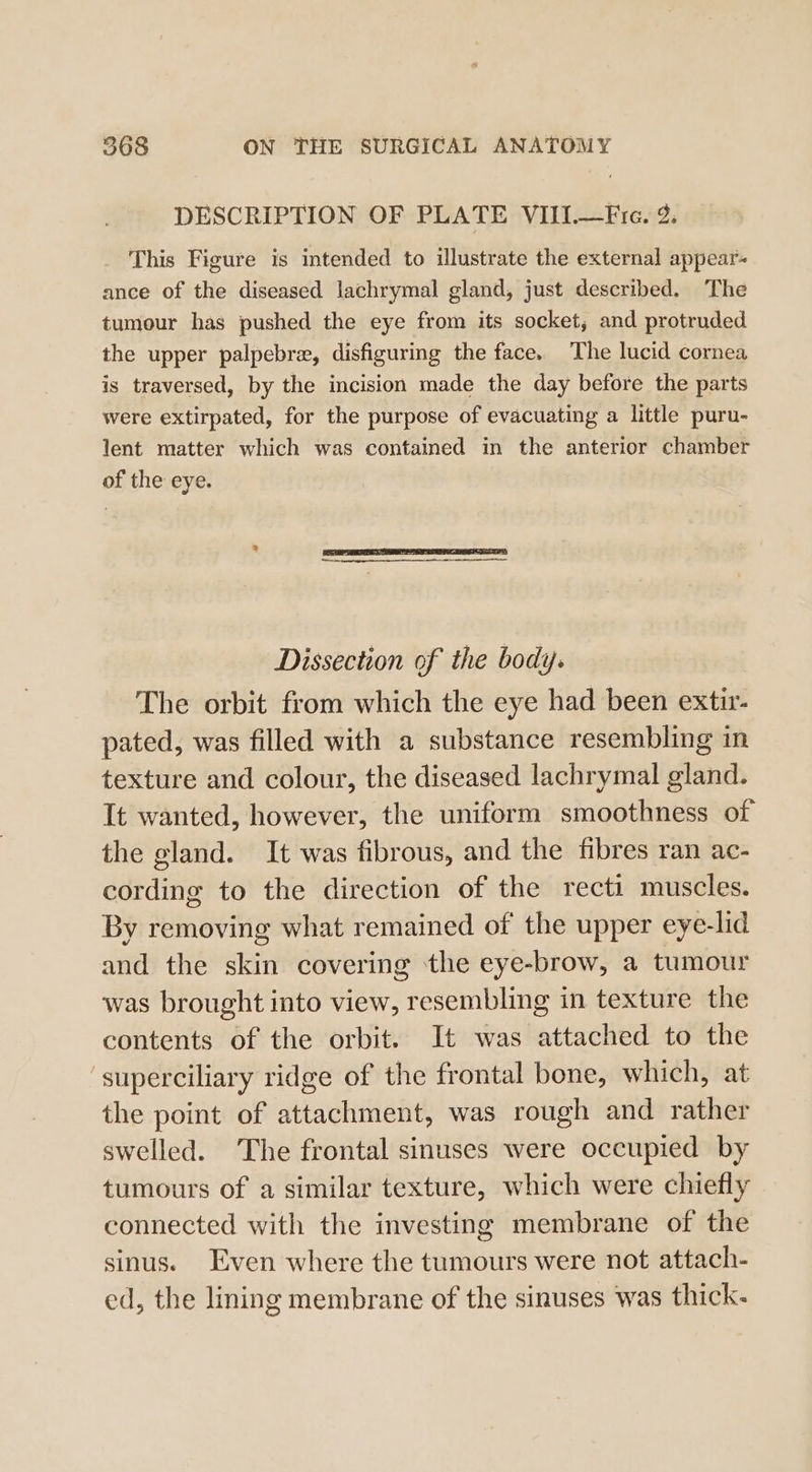 DESCRIPTION OF PLATE VIII.—Fre. 9. _ This Figure is intended to illustrate the external appear- ance of the diseased lachrymal gland, just described. The tumour has pushed the eye from its socket, and protruded the upper palpebre, disfiguring the face. The lucid cornea is traversed, by the incision made the day before the parts were extirpated, for the purpose of evacuating a little puru- lent matter which was contained in the anterior chamber of the eye. Dissection of the body. The orbit from which the eye had been extir- pated, was filled with a substance resembling in texture and colour, the diseased lachrymal gland. It wanted, however, the uniform smoothness of the gland. It was fibrous, and the fibres ran ac- cording to the direction of the recti muscles. By removing what remained of the upper eye-lid and the skin covering the eye-brow, a tumour was brought into view, resembling in texture the contents of the orbit. It was attached to the ‘superciliary ridge of the frontal bone, which, at the point of attachment, was rough and rather swelled. The frontal sinuses were occupied by tumours of a similar texture, which were chiefly connected with the investing membrane of the sinus. Even where the tumours were not attach- ed, the lining membrane of the sinuses was thick.