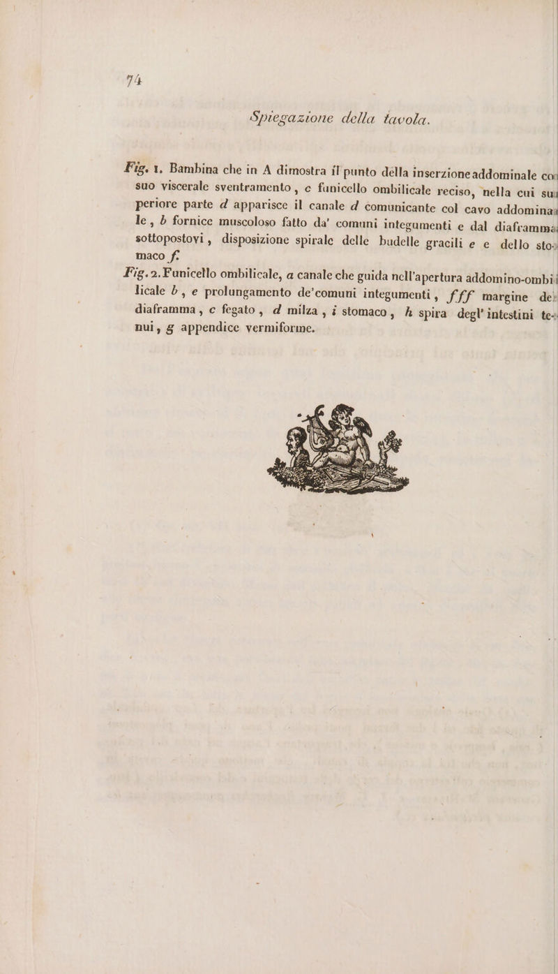 Spiegazione della tavola. Fig. 1, Bambina che in A dimostra il punto della inserzione addominale cor suo viscerale sventramento, c funicello ombilicate r eciso, nella cui sui periore parte d apparisce il canale d comunicante col cavo addominaî le, » fornice muscoloso fatto da’ comuni integumenti e dal diaframma sottopostovi, disposizione spirale delle budelle gracili e e dello stoo maco fi Fig.2.Funicello ombilicale, a canale che guida nell'apertura addomino-ombii licale 8, e prolungamento de’comuni integumenti s ffF margine dei diaframma, c fegato, d milza, i stomaco, &amp; spira degl’intestini te- nui, g appendice vermiforme.