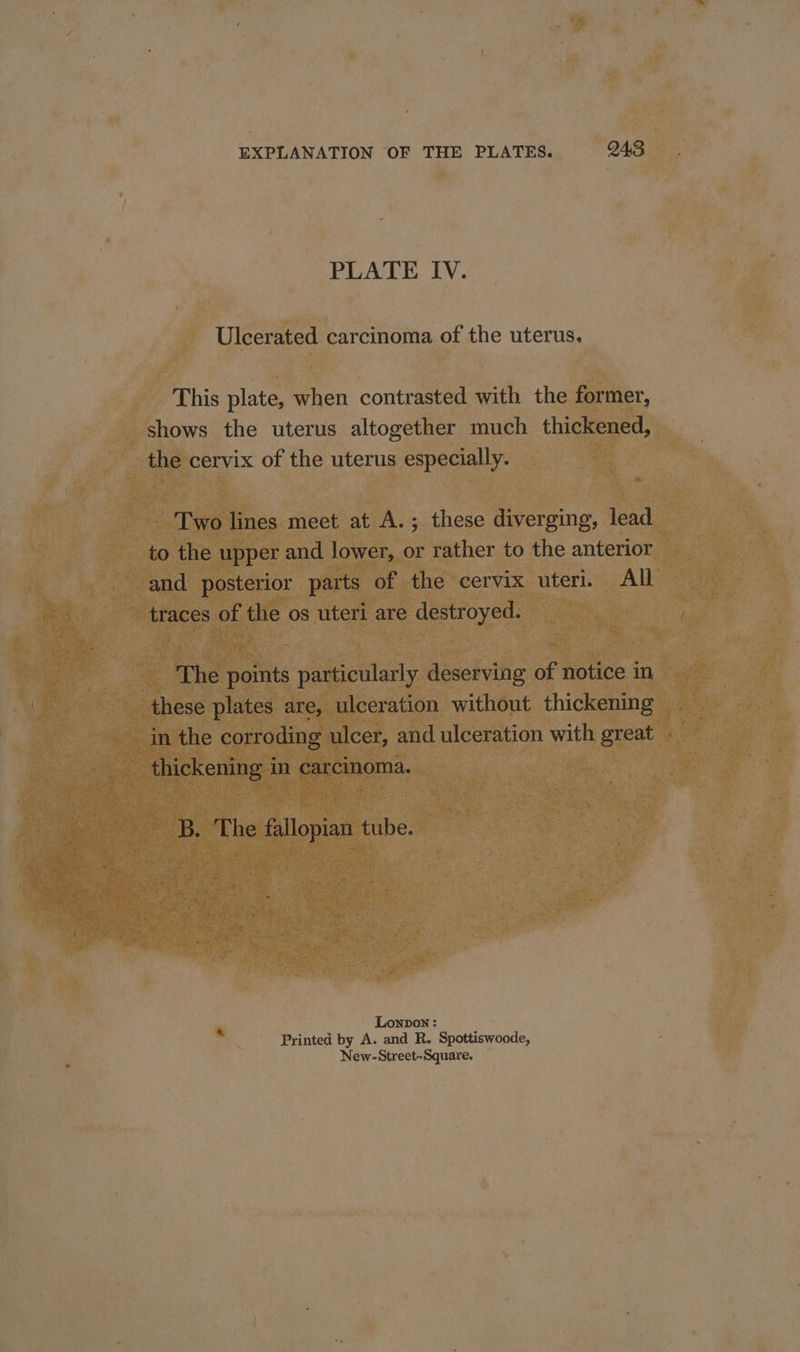 PLATE IV. Ulcerated carcinoma of the uterus. This plate, when contrasted with the former, shows the uterus altogether much thickened, — the cervix of the uterus especially. Two lines meet at A.; these diverging, lead to the upper and lower, or rather to the anterior : and posterior parts of the cervix uteri. All traces of the os uteri are destroyed. _ The points particularly deserving of notice in these plates are, ulceration without thickening in the corroding ulcer, and ulceration with great thickening in carcinoma. B. The fallopian tube. Lonpon : Printed by A. and R. Spottiswoode, New-Street-Square. «