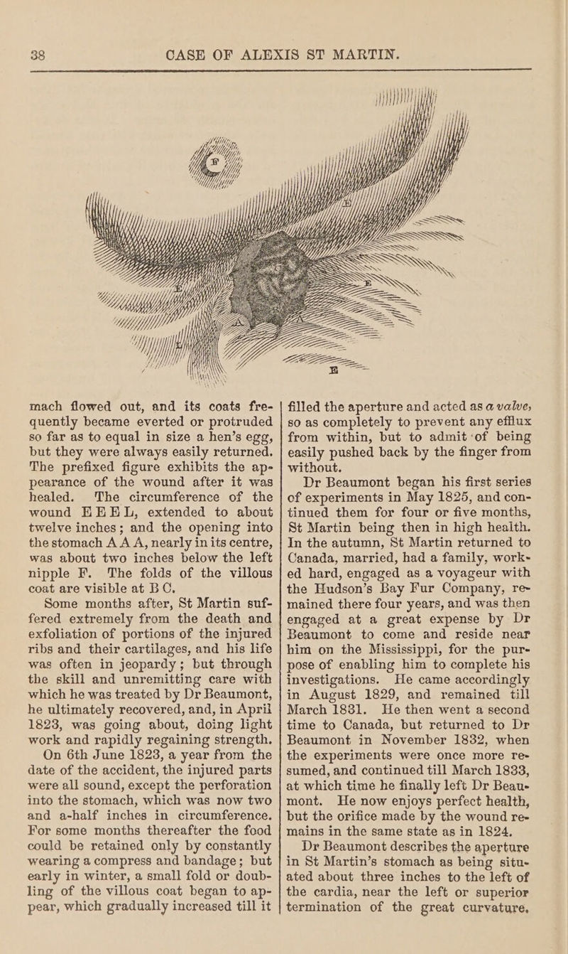 PMN ip MMi, YY wii Mae i ! NN Ws By ~~ > SS <—~_ = SS SS “iy , Yypeey) MY : th mach flowed out, and its coats fre- quently became everted or protruded so far as to equal in size a hen’s egg, but they were always easily returned. The prefixed figure exhibits the ap- pearance of the wound after it was healed. The circumference of the wound HEEL, extended to about twelve inches; and the opening into the stomach A A A, nearly in its centre, was about two inches below the left nipple F. The folds of the villous coat are visible at BC, Some months after, St Martin suf- fered extremely from the death and exfoliation of portions of the injured ribs and their cartilages, and his life was often in jeopardy; but through the skill and unremitting care with which he was treated by Dr Beaumont, he ultimately recovered, and, in April 1823, was going about, doing light work and rapidly regaining strength. On 6th June 1823, a year from the date of the accident, the injured parts were all sound, except the perforation into the stomach, which was now two and a-half inches in circumference. For some months thereafter the food could be retained only by constantly wearing a compress and bandage; but early in winter, a small fold or doub- ling of the villous coat began to ap- pear, which gradually increased till it Wh \, it Wa\\ Ney Wh} +) \y \’ filled the aperture and acted as a valve; so as completely to prevent any efflux from within, but to admit:of being easily pushed back by the finger from without. Dr Beaumont began his first series of experiments in May 1825, and con- tinued them for four or five months, St Martin being then in high health. In the autumn, St Martin returned to Canada, married, had a family, work~- ed hard, engaged as a voyageur with the Hudson’s Bay Fur Company, re~ mained there four years, and was then engaged at a great expense by Dr Beaumont to come and reside near him on the Mississippi, for the pur- pose of enabling him to complete his investigations. He came accordingly in August 1829, and remained till March 1881. He then went a second time to Canada, but returned to Dr Beaumont in November 1832, when the experiments were once more re- sumed, and continued till March 1833, at which time he finally left Dr Beau- mont. He now enjoys perfect health, but the orifice made by the wound re- mains in the same state as in 1824, Dr Beaumont describes the aperture in St Martin’s stomach as being situ- ated about three inches to the left of the cardia, near the left or superior termination of the great curvature,