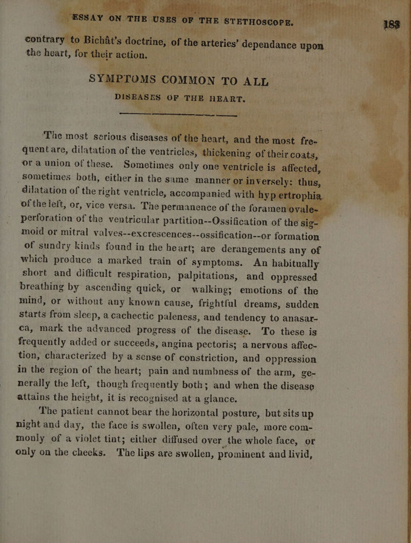 Rokdivatat nnd ge eau eae) Foy Maree ay 7 ‘The most serious diseases of t quent are, dilatation of the ventricles, tl ora union of these. Sometimes only on e Vi Sometimes both, either in the same manne dilatation of the right ventricle, accompanied wit of the left, or, vice versa. The permanence of the foramer perforation of the ventricular partition--Ossification of the yo moid or mitral valves--excrescences--ossification--or formation | of sundry kinds found in the he art; are derangements any of which produce a marked train of symptoms. An habitually short and difficult respiration, palpitations, and oppressed breathing by ascending quick, or walking; emotions of the mind, or without any known cause, frightful dreams, sudden starts from sleep, a cachectic paleness, and tendency to anasar- ca, mark the advanced progress of the disease. To these is frequently added or succeeds, angina pectoris; a nervous affec- tion, characterized by a sense of constriction, and oppression in the region of the heart; pain and numbness of the arm, ge- nerally the left, though frequently both; and when the disease attains the height, it is recognised at a glance. ‘The patient cannot bear the horizontal posture, but sits up night and day, the face is swollen, often very pale, more com- monly of a violet tint; either diffused over the whole face, or only on the cheeks. ‘The lips are swollen, prominent and livid,
