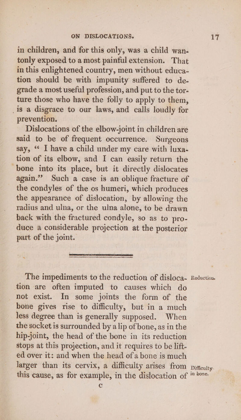 in children, and for this only, was a child wan- tonly exposed to a most painful extension. That in this enlightened country, men without educa- tion should be with impunity suffered to de. grade a most useful profession, and put to the tor- ture those who have the folly to apply to them, 1s a disgrace to our laws, and calls loudly for prevention. | Dislocations of the elbow-joint in children are said to be of frequent occurrence. Surgeons say, ** I have a child under my care with luxa- tion of its elbow, and I can easily return the bone into its place, but it directly dislocates again.”” Such a case is an oblique fracture of the condyles of the os humeri, which produces the appearance of dislocation, by allowing the radius and ulna, or the ulna alone, to be drawn back with the fractured condyle, so as to pro- duce a considerable projection at the posterior part of the joint. The impediments to the reduction of disloca- tion are often imputed to causes which do not exist. In some joints the form of the bone gives rise to difficulty, but in a much less degree than is generally supposed. When the socket is surrounded by a lip of'bone, as in the hip-joint, the head of the bone in its reduction stops at this projection, and it requires to be lift- ed over it: and when the head ofa bone is much larger than its cervix, a difficulty arises from this cause, as for example, in the dislocation of 4 Reduction. Difficulty. in bone.