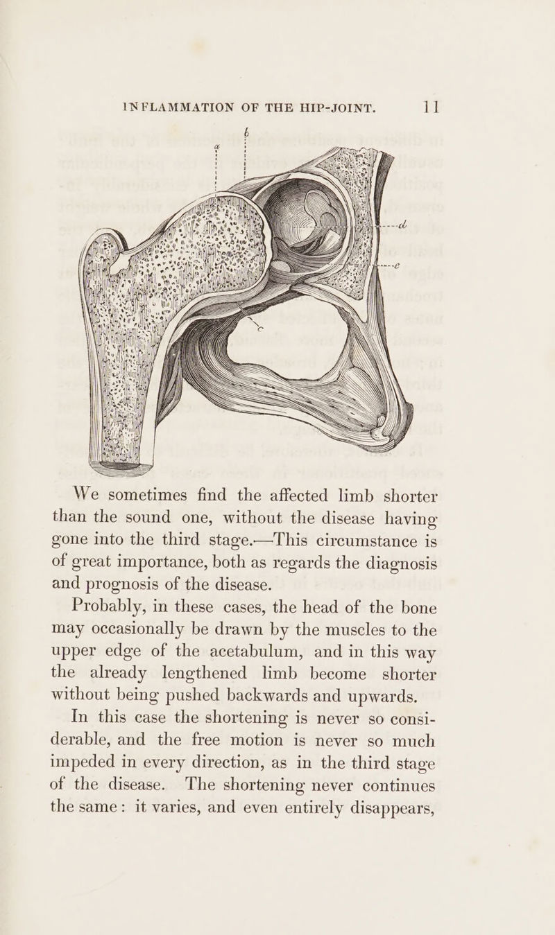 We sometimes find the affected limb shorter than the sound one, without the disease having gone into the third stage.—This circumstance is of great importance, both as regards the diagnosis and prognosis of the disease. Probably, in these cases, the head of the bone may occasionally be drawn by the muscles to the upper edge of the acetabulum, and in this way the already lengthened limb become shorter without being pushed backwards and upwards. In this case the shortening is never so consi- derable, and the free motion is never so much unpeded in every direction, as in the third stage of the disease. The shortening never continues the same : it varies, and even entirely disappears,