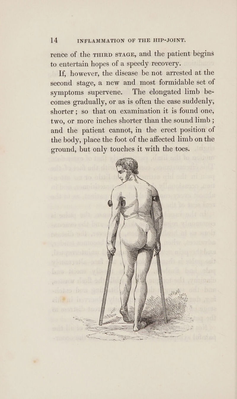 rence of the rH1rp sTaGE, and the patient begins to entertain hopes of a speedy recovery. If, however, the disease be not arrested at the second stage, a new and most formidable set of symptoms supervene. The elongated limb be- comes gradually, or as is often the case suddenly, shorter; so that on examination it is found one, two, or more inches shorter than the sound limb ; and the patient cannot, in the erect position of the body, place the foot of the affected limb on the eround, but only touches it with the toes.