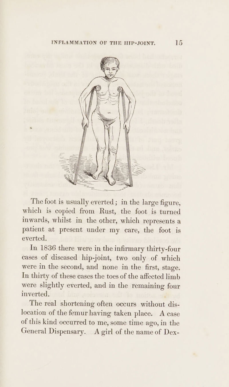 The foot is usually everted; in the large figure, which is copied from Rust, the foot is turned inwards, whilst in the other, which represents a patient at present under my care, the foot is everted. In 1836 there were in the infirmary thirty-four cases of diseased hip-joint, two only of which were in the second, and none in the first, stage. In thirty of these cases the toes of the affected limb were slightly everted, and in the remaining four inverted. The real shortening often occurs without dis- location of the femur having taken place. A case of this kind occurred to me, some time ago, in the General Dispensary. A girl of the name of Dex-