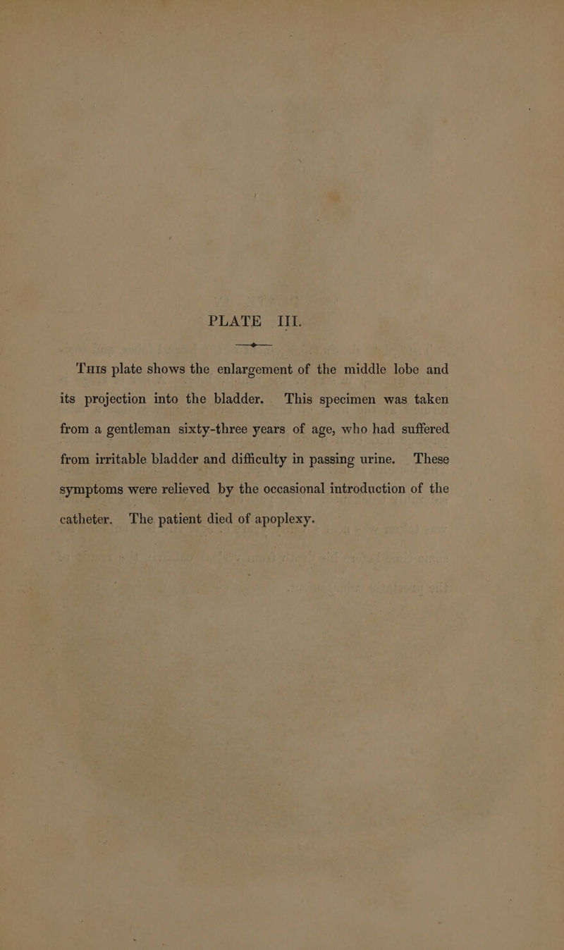 ee Tuts plate shows the enlargement of the middle lobe and its projection into the bladder.. This specimen was taken from a gentleman ee years of age, who had suffered from irritable bladder and difficulty in passing urine. These symptoms were relieved by the occasional introduction of the catheter. The patient died of apoplexy.
