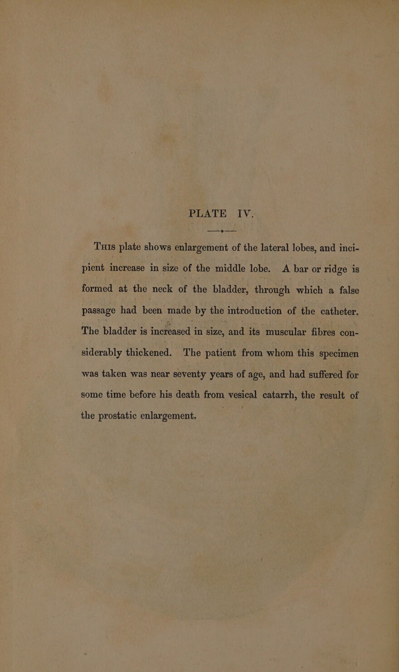 Tus plate shows enlargement of the lateral lobes, and inci- pient increase in size of the middle lobe. A bar or ridge is formed at the neck of the bladder, ehroush which a false passage had been made ey the introduction of the catheter. The bladder’ is increased i in size, ia its musonlar fpre con- siderably thickened. The eauees Goin whom this specimen was taken was near seventy years of age, and had suffered for some time before his death from vesical catarrh, the result of the prostatic enlargement.