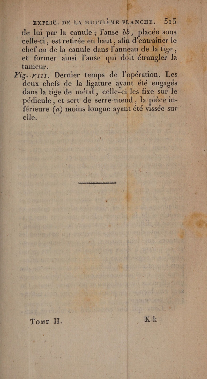 ÆXPLIC. DE LA HUITIÈME PL de lui par la canule ; l’anse #b, placée sous celle-ci, est retirée en haut, afin d'entraîner le chef aa GE la canule dans 1 anneau de lauge, et former ainsi l'anse qui doit étrangler BE. (1 1 tumeur. Fig. rrr1. péter temps de l'opération. Les deux chefs de la ligature ayant été engagés dans la tige de métal, celle-ci les fixe sur le pédicule , et sert de serre- nœud , la pièce in- férieure (a) n moins longue ayant été vissée sur elle, TomEr Il. _Kk :