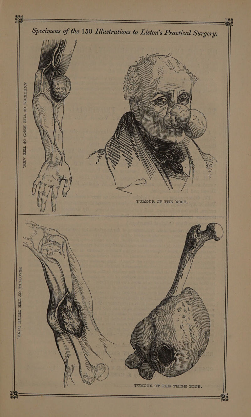 to Liston’s Practical Surgery. 7ons of the 150 LIllustrati Zmens oO Spec TUMOUR OF THE NOSE, TUMOUR OF THE THIGH BONE. w, \ \ to Bi a \ EDD