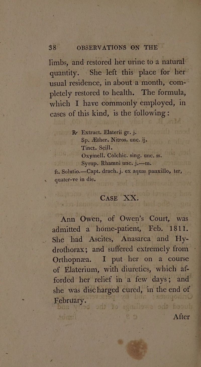 x limbs, and restored her urine to a atiak quantity. She left this place for her: pletely restored to health. The formula, which I have commonly employed, i cases of this kind, is the following : R Extract. Elaterii gr. j. Sp. Aither, Nitros. unc. ij. Tinct. Scill. Oxymell. Colchic. sing. unc. ss. Syrup. Rhamni unc. j.—m. fe. Solutio. —Capt. drach. j. ex aque panxillo, ter, quater-ve in die. CASE XX. Ann Owen, of Owen’s Court, was. admitted a home-patient, Feb. 1811. She had Ascites, Anasarca and Hy- drothorax; and suffered extremely from Orthopnea. I put her on a course of Elaterium, with diuretics, which af- forded her relief in a few days; and she was disc harged cured, in the end of After