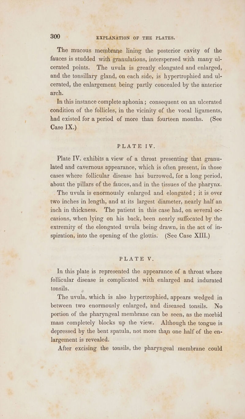 The mucous membrane lining the posterior cavity of the fauces is studded with granulations, interspersed with many ul- cerated points. The uvula is greatly elongated and enlarged, — and the tonsillary gland, on each side, is hypertrophied and ul- cerated, the enlargement being partly concealed by the anterior arch. In this instance complete aphonia ; consequent on an ulcerated condition of the follicles, in the vicinity of the vocal ligaments, had existed for a period of more than fourteen months. (See Case IX.) PALATES Y). Plate IV. exhibits a view of a throat presenting that granu- lated and cavernous appearance, which is often present, in those cases where follicular disease has burrowed, for a long period, about the pillars of the fauces, and in the tissues of the pharynx. _ The uvula is enormously enlarged and elongated ; it is over two inches in length, and at its largest diameter, nearly half an inch in thickness. The patient in this case had, on several oc- casions, when lying on his back, been nearly suffocated by the extremity of the elongated uvula being drawn, in the act of in- spiration, into the opening of the glottis. (See Case XIII.) PLAT Ey In this plate is represented the appearance of a throat where follicular disease is complicated with enlarged and indurated tonsils. The uvula, which is also hypertrophied, appears wedged in between two enormously enlarged, and diseased tonsils. No portion of the pharyngeal membrane can be seen, as the morbid mass completely blocks up the view. Although the tongue is depressed by the bent spatula, not more than one half of the en- largement is revealed. After excising the tonsils, the pharyngeal membrane could |