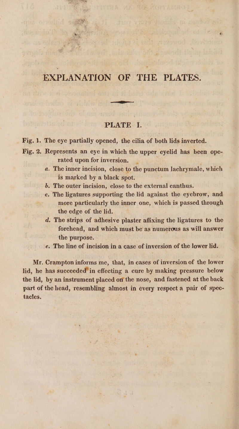 EXPLANATION OF THE PLATES. PLATE I. Fig, }. The eye partially opened, the cilia of both lids inverted. Fig. 2. Represents an eye in which the upper eyelid has been ope- rated upon for inversion. ; a. The inner incision, close to the punctum lachrymale, which is marked by a black spot. b. The outer incision, close to the external canthus. e. The ligatures supporting the lid against the eyebrow, and more particularly the inner one, which is passed through the edge of the lid. d, The strips of adhesive plaster affixing the ligatures to the forehead, and which must be'as numerous as will answer the purpose. e. The line of incision in a case of inversion of the lower lid. Mr. Crampton informs me, that, in cases of inversion of the lower lid, he has succeeded’ in effecting a cure by making pressure below the lid, by an instrument placed on the nose, and fastened at the back part of the head, resembling almost in every respect a pair of spec- tacles.