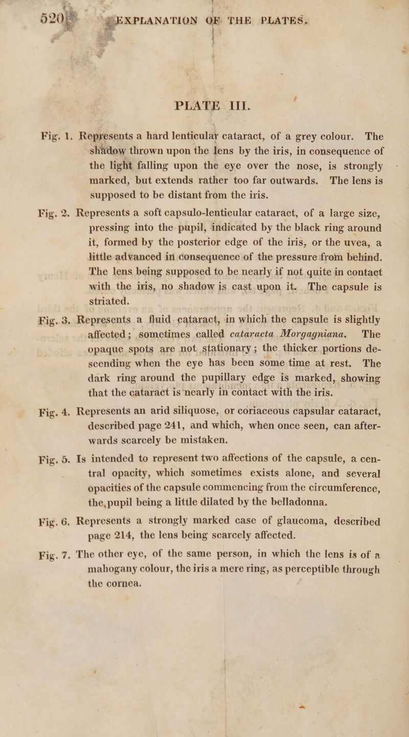 to Fig. y } Rs 5 Represents a hard lenticular cataract, of a grey colour. The shadow thrown upon the lens by the iris, in consequence of the light falling upon the eye over the nose, is strongly marked, but extends rather too far outwards. The lens is supposed to be distant from the iris. pressing into the pupil, indicated by the black ring around it, formed by the posterior edge of the iris, or the uvea, a little advanced in Consequence of the pressure from behind. The lens being supposed to be nearly if not quite in contact with the iris, no shadow is cast upon it.. The capsule is striated. Represents a fluid. cataract, in which the capsule is slightly affected; sometimes called cataracta Morgagniana. The opaque spots are not stationary; the thicker portions de- scending when the eye has been some time at rest. The dark ring around the pupillary edge is marked, Showing that the cataract is nearly in contact with the iris. described page 241, and which, when once seen, can after- wards scarcely be mistaken. tral opacity, which sometimes exists alone, and several opacities of the capsule commencing from the circumference, the,pupil being a little dilated by the belladonna, page 214, the lens being scarcely affected. mahogany colour, the iris a mere ring, as perceptible through the cornea,