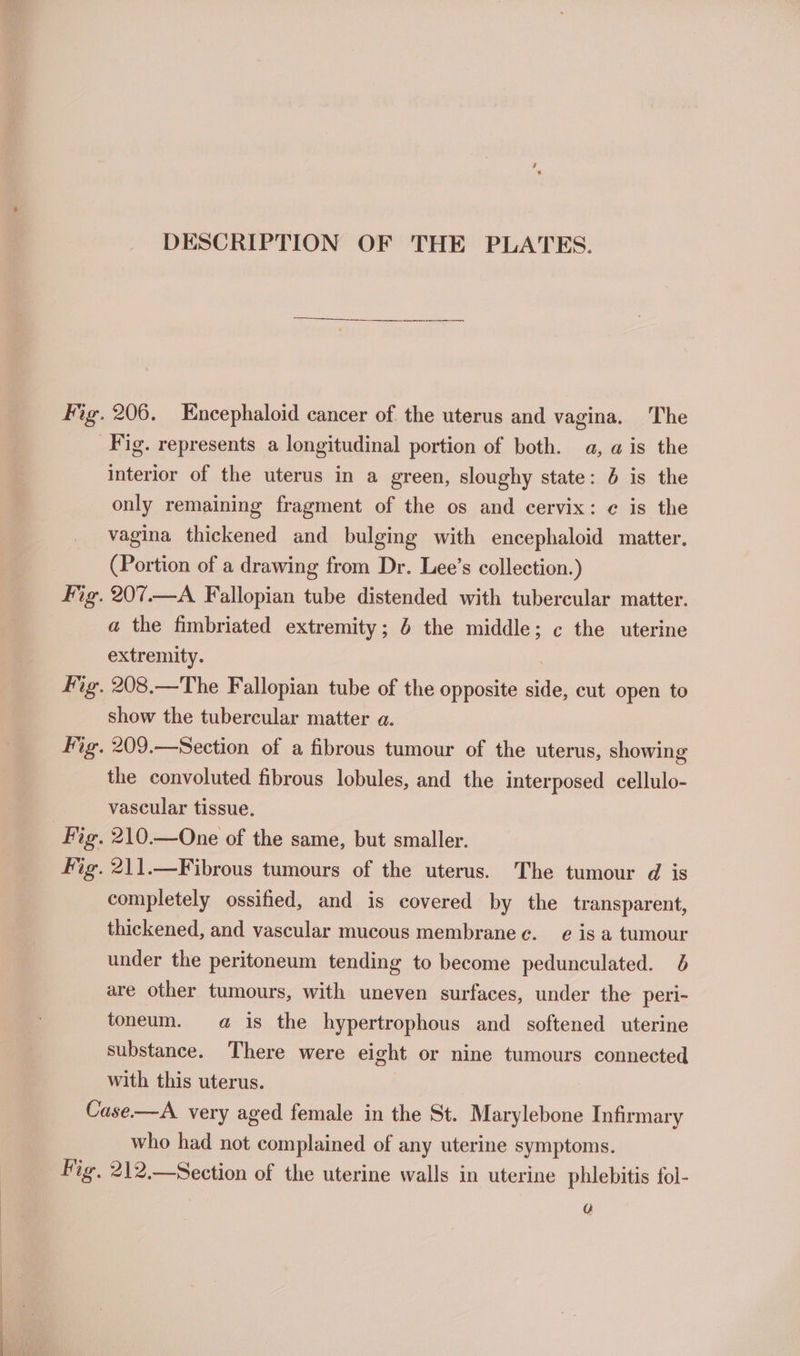 DESCRIPTION OF THE PLATES. Fig. 206. Encephaloid cancer of the uterus and vagina. The Fig. represents a longitudinal portion of both. a, a is the interior of the uterus in a green, sloughy state: 6 is the only remaining fragment of the os and cervix: ¢ is the vagina thickened and bulging with encephaloid matter. (Portion of a drawing from Dr. Lee’s collection.) Fig. 207.—A Fallopian tube distended with tubercular matter. a the fimbriated extremity; &amp; the middle; ¢ the uterine extremity. fig. 208.—The Fallopian tube of the opposite ag cut open to show the tubercular matter a. Fig. 209.—Section of a fibrous tumour of the uterus, showing the convoluted fibrous lobules, and the interposed cellulo- vascular tissue. | Fig. 210.—One of the same, but smaller. Fig. 211.—Fibrous tumours of the uterus. The tumour d is completely ossified, and is covered by the transparent, thickened, and vascular mucous membrane ec. e is a tumour under the peritoneum tending to become pedunculated. 5 are other tumours, with uneven surfaces, under the peri- toneum. @ is the hypertrophous and softened uterine substance. There were eight or nine tumours connected with this uterus. Case.—A very aged female in the St. Marylebone Infirmary who had not complained of any uterine symptoms. Fig, 212.—Section of the uterine walls in uterine phlebitis fol- Q