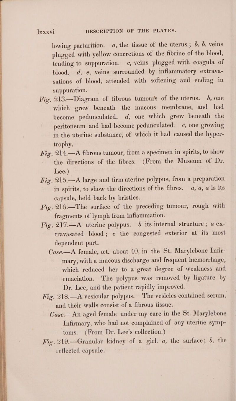 lowing parturition. 4, the tissue of the uterus ; 6, 6, veins plugged with yellow concretions of the fibrine of the blood, tending to suppuration. c¢, veins plugged with coagula of blood. d, e, veins surrounded by inflammatory extrava- sations of blood, attended with softening and ending in suppuration. Fig. 213.—Diagram of fibrous tumours of the uterus. 6, one which grew beneath the mucous membrane, and had become pedunculated. d, one which grew beneath the Pp 8 peritoneum and had become pedunculated. ¢, one growing in the uterine substance, of which it had caused the hyper- trophy. Fig, 214.—A fibrous tumour, from a specimen in spirits, to show the directions of the fibres. (From the Museum of Dr. Lee.) Fig. 215.—A large and firm uterine polypus, from a preparation in spirits, to show the directions of the fibres. a, a, a is its capsule, held back by bristles. | Fig. 216.—The surface of the preceding tumour, rough with fragments of lymph from inflammation. Fig. 217.—A uterine polypus. 6 its internal structure; @ ex- travasated blood; ¢ the congested exterior at its most dependent part. Case.—A female, xt. about 40, in the St. Marylebone Infir- mary, with a mucous discharge and frequent hemorrhage, which reduced her to a great degree of weakness and emaciation. The polypus was removed by ligature by Dr. Lee, and the patient rapidly improved. Fig. 218.—A vesicular polypus. The vesicles contained serum, and their walls consist of a fibrous tissue. Case.—An aged female under my care in the St. Marylebone Infirmary, who had not complained of any uterine symp- toms. (From Dr. Lee’s collection.) Fig. 219.—Granular kidney of a girl. a, the surface; 6, the ii reflected capsule. ii}