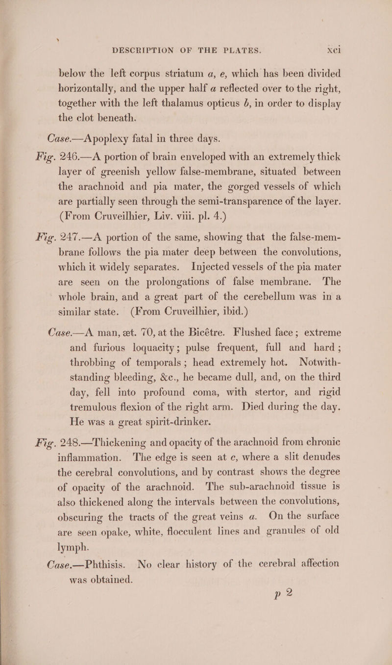 below the left corpus striatum a, e, which has been divided horizontally, and the upper half @ reflected over to the right, together with the left thalamus opticus 6, in order to display the clot beneath. Case.—Apoplexy fatal in three days. Fig. 246.—A portion of brain enveloped with an extremely thick layer of greenish yellow false-membrane, situated between the arachnoid and pia mater, the gorged vessels of which are partially seen through the semi-transparence of the layer. (From Cruveilhier, Liv. vii. pl. 4.) Fig. 247.—A portion of the same, showing that the false-mem- brane follows the pia mater deep between the convolutions, which it widely separates. Injected vessels of the pia mater are seen on the prolongations of false membrane. The whole brain, and a great part of the cerebellum was in a similar state. (From Cruveilhier, ibid.) Case.—A man, et. 70, at the Bicétre. Flushed face; extreme and furious loquacity; pulse frequent, full and hard ; throbbing of temporals ; head extremely hot. Notwith- standing bleeding, &amp;c., he became dull, and, on the third day, fell into profound coma, with stertor, and rigid tremulous flexion of the right arm. Died during the day. He was a great spirit-drinker. Fig, 248.—Thickening and opacity of the arachnoid from chronic inflammation. The edge is seen at c, where a slit denudes the cerebral convolutions, and by contrast shows the degree of opacity of the arachnoid. The sub-arachnoid tissue 1s also thickened along the intervals between the convolutions, obscuring the tracts of the great veins a. On the surface are seen opake, white, floeculent lines and granules of old lymph. Case.—Phthisis. No clear history of the cerebral affection was obtained. p 2