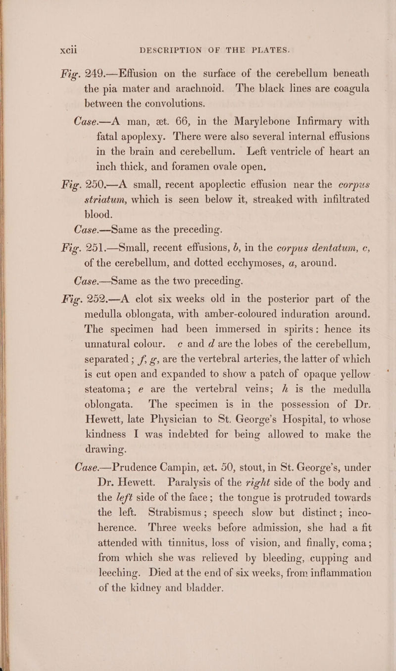 Fig. 249.—Effusion on the surface of the cerebellum beneath the pia mater and arachnoid. The black lines are coagula between the convolutions. Case-—A man, xt. 66, in the Marylebone Infirmary with fatal apoplexy. There were also several internal effusions in the brain and cerebellum. Left ventricle of heart an inch thick, and foramen ovale open. Fig. 250.—A small, recent apoplectic effusion near the corpus striatum, which is seen below it, streaked with infiltrated blood. Case.—Same as the preceding. Fig. 251.—Small, recent effusions, 6, in the corpus dentatum, ec, of the cerebellum, and dotted ecchymoses, a, around. Case.—Same as the two preceding. Fig. 252.—A clot six weeks old in the posterior part of the medulla oblongata, with amber-coloured induration around. The specimen had been immersed in spirits: hence its unnatural colour. ce and d are the lobes of the cerebellum, separated ; f, g, are the vertebral arteries, the latter of which is cut open and expanded to show a patch of opaque yellow steatoma; e are the vertebral veins; h is the medulla oblongata. The specimen is in the possession of Dr. Hewett, late Physician to St. George’s Hospital, to whose kindness I was indebted for being allowed to make the drawing. Case.——Prudence Campin, zt. 50, stout, in St. George’s, under Dr. Hewett. Paralysis of the right side of the body and _ the /eft side of the face; the tongue is protruded towards the left. Strabismus; speech slow but distinct; inco- herence. ‘Three weeks before admission, she had a fit attended with tinnitus, loss of vision, and finally, coma; from which she was relieved by bleeding, cupping and leeching. Died at the end of six weeks, from inflammation of the kidney and bladder.