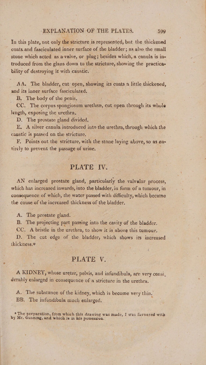 In this plate, not only the stricture is represented, but the thickened coats.and fasciculated inner surface of the bladder; as also the small stone which acted as avalve, or plug; besides which, a canula is ins troduced from the glans down to the stricture, showing the practicas bility of destengig it with caustic. AA. The piade, cut open, showing its coats a little thickened, and its inner surface fasciculated. _ aie B. The body of the penis, CC. The corpus spongiosum urethre, cut open through its whule length, exposing the urethra. D. The prostate gland divided. E. A silver canula introduced into the urethra, through which the caustic is passed on the stricture. F. Points out the stricture, with the stone laying above, So as en- tirely to prevent the passage of urine. PLATE IV. AN enlarged prostate gland, particularly the valvular process, which has increased inwards, into the bladder, in form of a tumour, in consequence of which, the water passed with difficulty, which became _ the cause of the increased thickness of the bladder. A. The prostate gland. , B. The projecting part passing into the cavity of the bladder. CC. A bristle in the urethra, to show it is above this tumour, D. The cut edge of the pee, which shows its increased thickness.* PLATE V. A KIDNEY, whose ureter, pelvis, and infundibula, are very consi, derably enlarged in consequence of a stricture in the urethra. A. The substance of the kidney, which is become very thin. BB. The infundibula much enlarged. * The preparation, from which this drawing was made, I was favoured with by Mr, Guuning, and which is in his Possession.