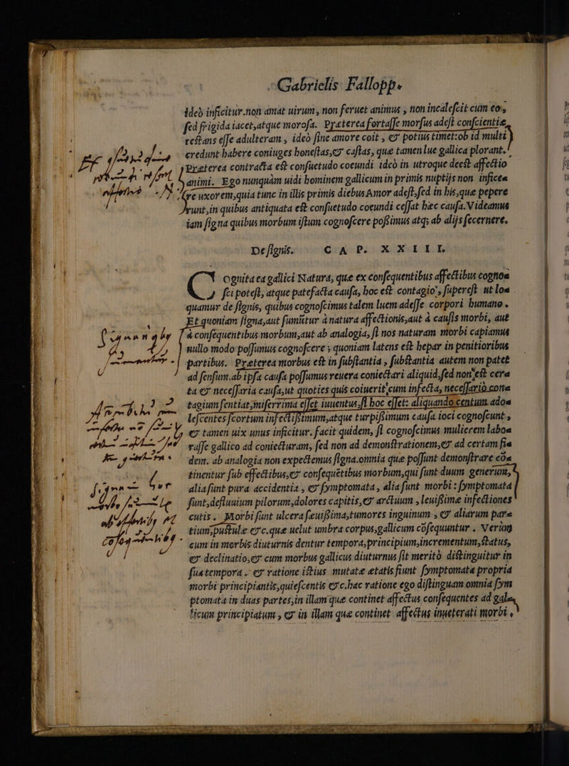 and uia: iati a 1T a UA Cae P s Qui ba No NC ETMAE nn RS AN cou rt ea Wal SOpncN Gabrielis: Fallopp. ddeb inficitur.non amat uirum , non feruet animus , tion incalefcit cum to, fcd frigida iacet, atque morofa. Pyeterea ortajfe morfus adeft confcientie, re&amp;ans elfe adulteram , ideó [ine amore coit &amp;9 potius timet:ob id multi —— am 24 (fnt Preterea contracta est confuetudo coeundi idco in utroque deest affectio : i animi. Egonumquam uidi bominem gallicum in primis nuptijs non infict« illi -/) re uxor enquia tunc in illis primis diebus Amor adeft, fed in bis,que pepere unt;in quibus antiquata eft confuetudo cocundi ceJJat bac caufa. V ideamus iam fig na quibus morbum iftum cognofcere pofsimus atq; ab dlijs fecernere. De fignis. CAP. XXIIIL ( Y ognita ca gallici Natura, que ex confequentibus affectibus cogtiou quamur de fignis, quibus cognofcimus talem luem ade[Je corpori bumaneo . t quoniam fignayaut fumitur à natura affectionis,aut à caufis morbi, aut à conféquentibus morbum,aut ab analogia, fi nos naturam morbi capiam (A //, ] nullo modo poffumus cognofcere » quoniam latens esb hepar in penitioribus A fad  : , ] ' ^ - | partibus. Preterea morbus eft in fubftantia , fubslantia. autem non pate£ ad fenfum.ab ipfa caufa po[Jumus veuera coniectari aliquid.fed nomest cera ta e? neceffaria caufa,ut quoties quis coiuerit cum infecta, nece]Jario cotte dam bh pj jj tagium fentiatymiferrima eJ) 26 | 120 A PTUS US deentesfcortum infecifumum,atque turpifsimum caufa ioci cognofcunt , rmm Ü €7 tamen uix unus inficitur. facit quidem, fl cognofcimu mulierem labou mi Lu va[fc gallico ad coniecturam, fed non ad demonftrationem,e7 ad certam fie deu. ab analogéa non expectemus ffgna.oimnia que po[Junt demonftrare có« tinentur fub effectibus, confequétibus morbum,qui funt duum generum, alia funt pura accidentia , «y fymptomata , alia funt. morbi : fymptomata funt; defluuium pilorum,dolores capitis, arctuum , leuiftime infectiones  Y Aq cutis. Morbi fant ulcera feeuifsima;tumores inguinum , &amp; aliarum pare | tiunipustule ezc.que uclut umbra corpus,gallicum cofequuntur , Veriau va LA. emin morbis diuturnis dentur tempora,principium,incrementum; Status, € declinatio,ey cum morbus gallicus diuturnus fit meritó. distinguitur in fla tempora . «y ratione iftius mutat etatis fiunt. (ymptomata propria morbi principiantis,quiefcentis ez'c.hac vatione ego diftinguam omnia fm cum principiatum , ey in illam que continet: affectus inueterati morbi —