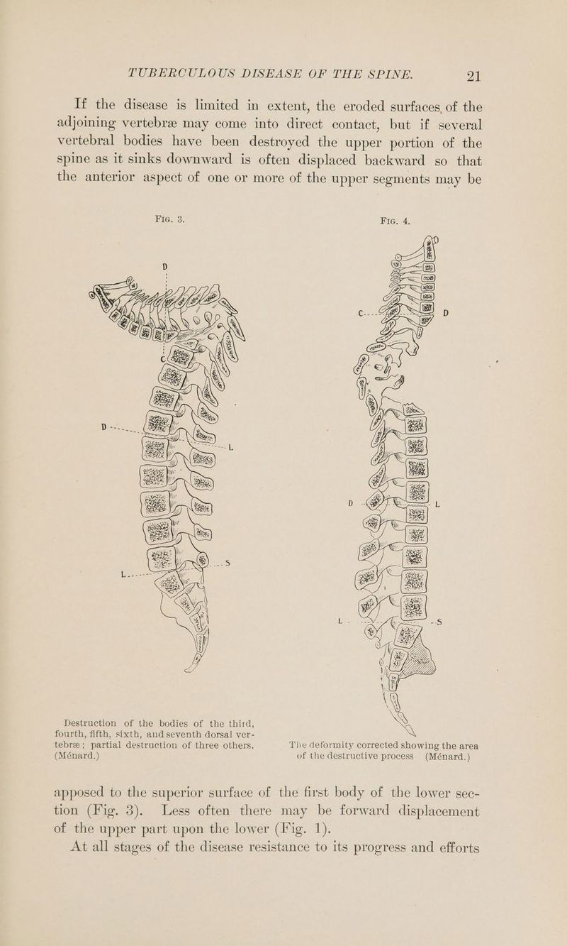 If the disease is limited in extent, the eroded surfaces of the adjoining vertebree may come into direct contact, but if several vertebral bodies have been destroyed the upper portion of the spine as it sinks downward is often displaced backward so that the anterior aspect of one or more of the upper segments may be Destruction of the bodies of the third, fourth, fifth, sixth, and seventh dorsal ver- tebre ; partial destruction of three others. The deformity corrected showing the area (Ménard.) of the destructive process (Ménard.) apposed to the superior surface of the first body of the lower sec- tion (Fig. 3). Less often there may be forward displacement of the upper part upon the lower (Fig. 1). At all stages of the disease resistance to its progress and efforts