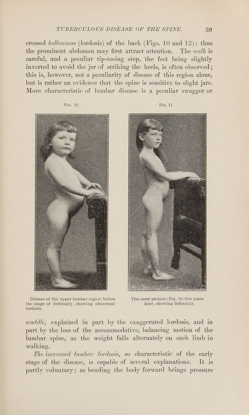 creased hollowness (lordosis) of the back (Figs. 10 and 12); thus the prominent abdomen may first attract attention. The walk is careful, and a peculiar tip-toeing step, the feet being slightly inverted to avoid the jar of striking the heels, is often observed ; this is, however, not a peculiarity of disease of this region alone, but is rather an evidence that the spine is sensitive to slight jars. More characteristic of lumbar disease is a peculiar swagger or Pres 10: Fre, 11). Disease of the upper lumbar region before The same patient (Fig. 10) five years the stage of deformity, showing abnormal later, showing deformity. lordosis. waddle, explained in part by the exaggerated lordosis, and in part by the loss of the accommodative, balancing motion of the lumbar spine, as the weight falls alternately on each limb in walking. The increased lumbar lordosis, so characteristic of the early stage of the disease, is capable of several explanations. It is partly voluntary ; as bending the body forward brings pressure