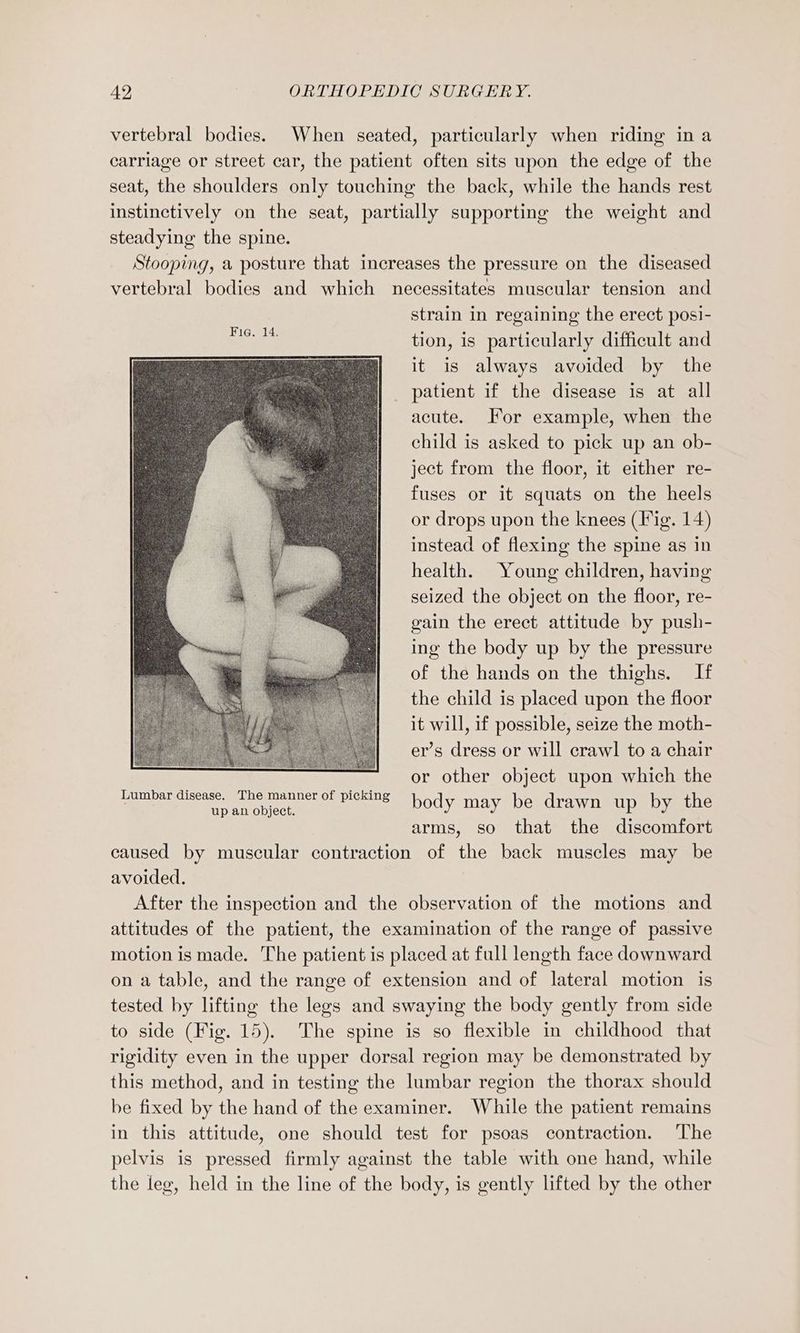 vertebral bodies. When seated, particularly when riding in a carriage or street car, the patient often sits upon the edge of the seat, the shoulders only touching the back, while the hands rest instinctively on the seat, partially supporting the weight and steadying the spine. Stooping, a posture that increases the pressure on the diseased vertebral bodies and which necessitates muscular tension and strain in regaining the erect posi- tion, is particularly difficult and it is always avoided by the patient if the disease is at all acute. For example, when the child is asked to pick up an ob- ject from the floor, it either re- fuses or it squats on the heels or drops upon the knees (Fig. 14) instead of flexing the spine as in health. Young children, having seized the object on the floor, re- gain the erect attitude by push- ing the body up by the pressure of the hands on the thighs. If the child is placed upon the floor it will, if possible, seize the moth- er’s dress or will crawl to a chair or other object upon which the body may be drawn up by the arms, so that the discomfort caused by muscular contraction of the back muscles may be avoided. After the inspection and the observation of the motions and attitudes of the patient, the examination of the range of passive motion is made. The patient is placed at full length face downward on a table, and the range of extension and of lateral motion is tested by lifting the legs and swaying the body gently from side to side (Fig. 15). The spine is so flexible in childhood that rigidity even in the upper dorsal region may be demonstrated by this method, and in testing the lumbar region the thorax should be fixed by the hand of the examiner. While the patient remains in this attitude, one should test for psoas contraction. The pelvis is pressed firmly against the table with one hand, while the leg, held in the line of the body, is gently lifted by the other Lumbar disease. The manner of picking up an object.