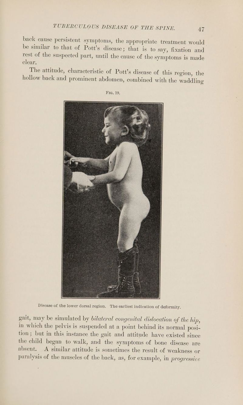 back cause persistent symptoms, the appropriate treatment would be similar to that of Pott’s disease ; that is to say, fixation and rest of the suspected part, until the cause of the symptoms is made clear. The attitude, characteristic of Pott’s disease of this region, the hollow back and prominent abdomen, combined with the waddling Disease of the lower dorsal region. The earliest indication of deformity. gait, may be simulated by bilateral congenital dislocation of the hip, in which the pelvis is suspended at a point behind its normal posi- tion; but in this instance the gait and attitude have existed since the child began to walk, and the symptoms of bone disease are absent. A similar attitude is sometimes the result of weakness or paralysis of the muscles of the back, as, for example, in progressive