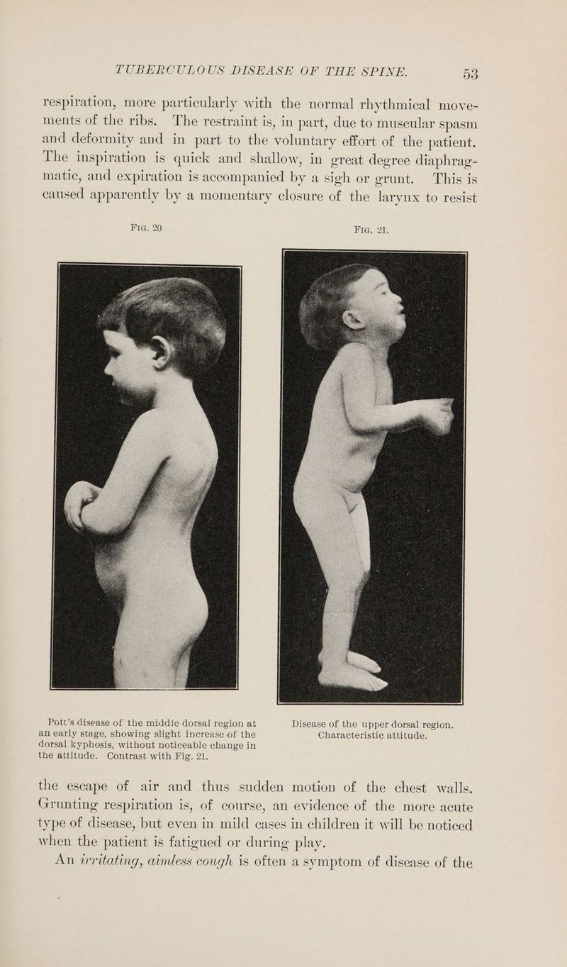 respiration, more particularly with the normal rhythmical move- ments of the ribs. The restraint is, in part, due to muscular spasm and deformity and in part to the voluntary effort of the patient. The inspiration is quick and shallow, in great deerce diaphrag- matic, and expiration is accompanied by a sigh or grunt. This is caused apparently by a momentary closure of the larynx to resist Pott’s disease of the middle dorsal region at Disease of the upper dorsal region. an early stage, showing slight increase of the Characteristic attitude. dorsal kyphosis, without noticeable change in the attitude. Contrast with Fig. 21. the escape of air and thus sudden motion of the chest walls. Grunting respiration is, of course, an evidence of the more acute type of disease, but even in mild cases in children it will be noticed when the patient is fatigued or during play. An irritating, aimless cough is often a symptom of disease of the