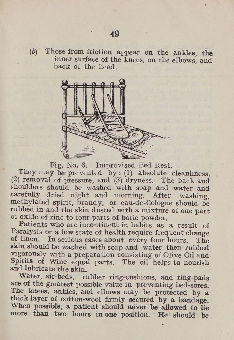 (b) Those from friction appear on the ankles, the inner surface of the knees, on the elbows, and back of the head. They may be prevented by: (1) absolute cleanliness, (2) removal of pressure, and (3) dryness. The back and shoulders should be washed with soap and water and carefully dried night and morning. After washing, methylated spirit, brandy, or eau-de-Cologne should be rubbed in and the skin dusted with a mixture of one part of oxide of zinc to four parts of boric powder, Patients who are incontinent in habits as a result of Paralysis or a low state of health require frequent change of linen. In serious cases about every four hours. The skin should be washed with soap and water then rubbed vigorously with a preparation consisting of Olive Oil and Spirits of Wine equal parts. The oil helps to nourish and lubricate the skin. Water, air-beds, rubber ring-cushions, and ring-pads are of the greatest possible value in preventing bed-sores. The knees, ankles, and elbows may be protected by a thick layer of cotton-wool firmly secured by a bandage. When possible, a patient should never be allowed to lie more than two hours in one position. He’ should be