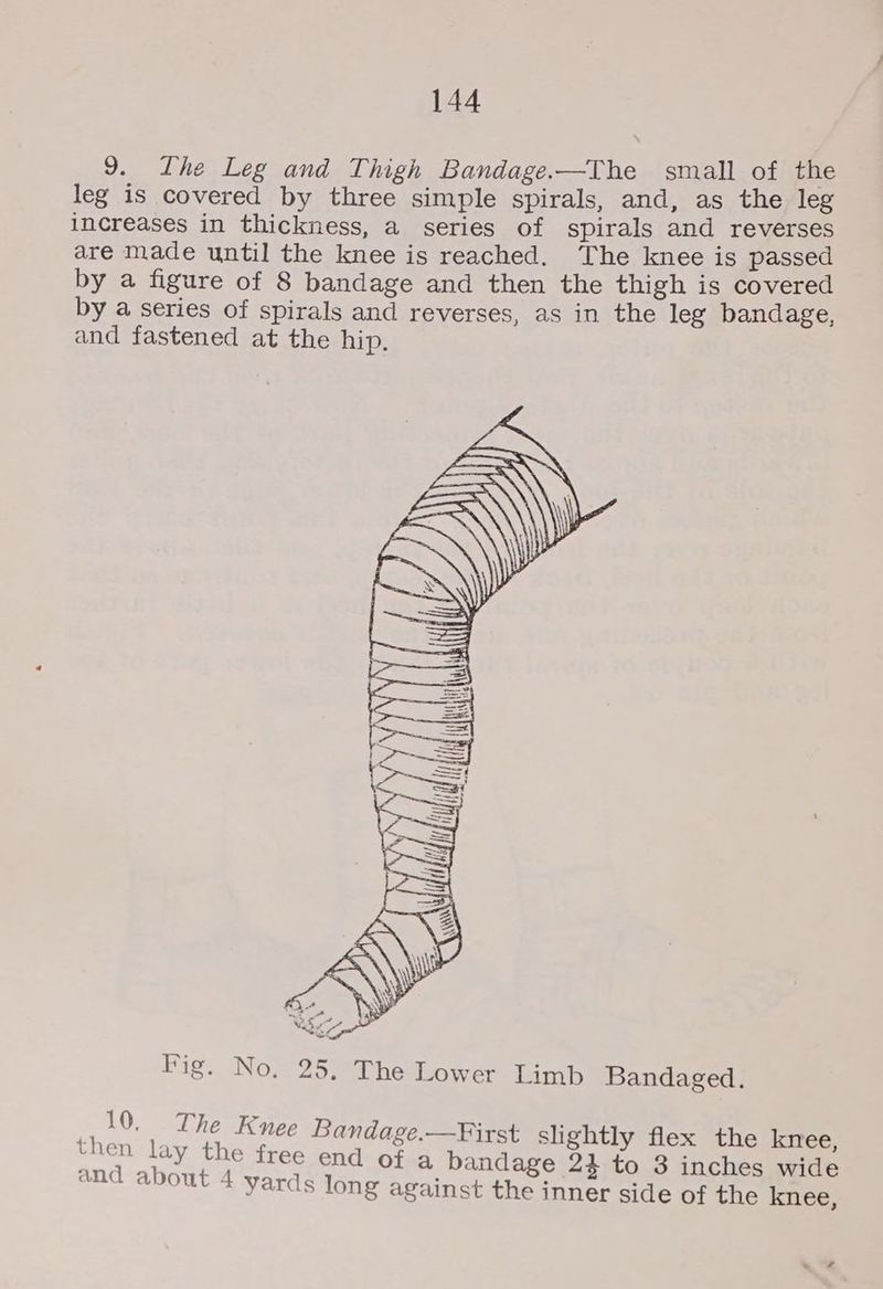 9. Lhe Leg and Thigh Bandage.—The small of the leg is covered by three simple spirals, and, as the leg increases in thickness, a series of spirals and reverses are made until the knee is reached. The knee is passed by a figure of 8 bandage and then the thigh is covered by a series of spirals and reverses, as in the leg bandage, and fastened at the hip. Big: No. 225.2? heauower im Bandaged. 10. The Knee Bandage.—First slightly flex the knee, then lay the free end of a bandage 24 to 3 inches wide and about 4 yards long against the inner side of the knee,