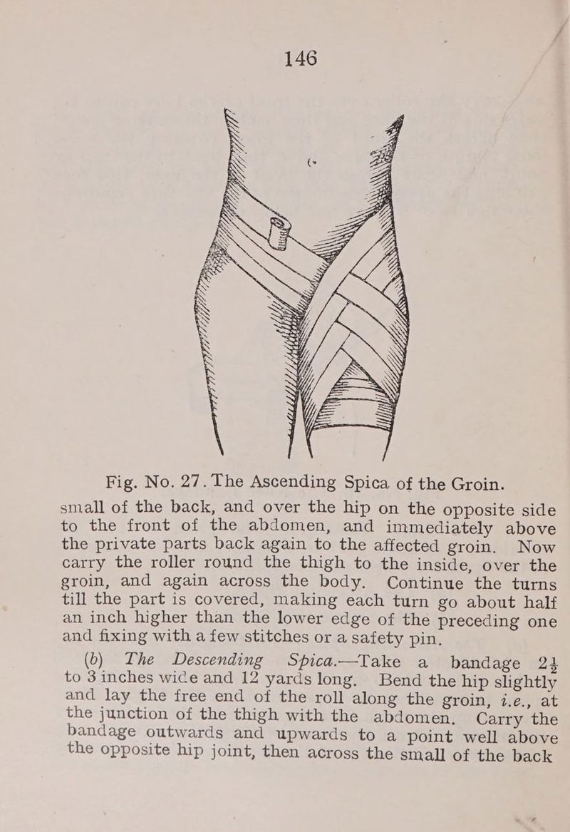 small of the back, and over the hip on the opposite side to the front of the abdomen, and immediately above the private parts back again to the affected groin. Now carry the roller round the thigh to the inside, over the groin, and again across the body. Continue the turns till the part is covered, making each turn go about half an inch higher than the lower edge of the preceding one and fixing with a few stitches or a safety pin. (0) Lhe Descending Spica.—Take a bandage 2} to 3 inches wice and 12 yards long. Bend the hip slightly and lay the free end of the roll along the groin, i.e., at the junction of the thigh with the abdomen. Carry the bandage outwards and upwards to a point well above the opposite hip joint, then across the small of the back