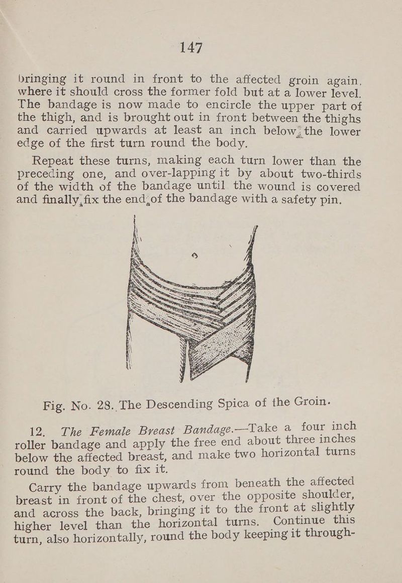 bringing it round in front to the affecte where it should cross the former fold but ae a he The bandage is now made to encircle the upper part of the thigh, and is brought out in front between the thighs and carried upwards at least an inch below. the eae edge of the first turn round the body. = Repeat these turns, making each turn lower th preceding one, and over-lapping it by about are of the width of the bandage until the wound is covered and finally, fix the end,of the bandage with a safety pin. Fig. No. 28. The Descending Spica of the Groin. 12. The Female Breast Bandage.—Take a four inch roller bandage and apply the free end about three inches below the affected breast, and make two horizontal turns round the body to fix it. Carry the bandage upwards from beneath the affected breast in front of the chest, over the opposite shoulder, and across the back, bringing it to the front at slightly higher level than the horizontal turns. Continue this turn, also horizontally, round the body keeping it through-