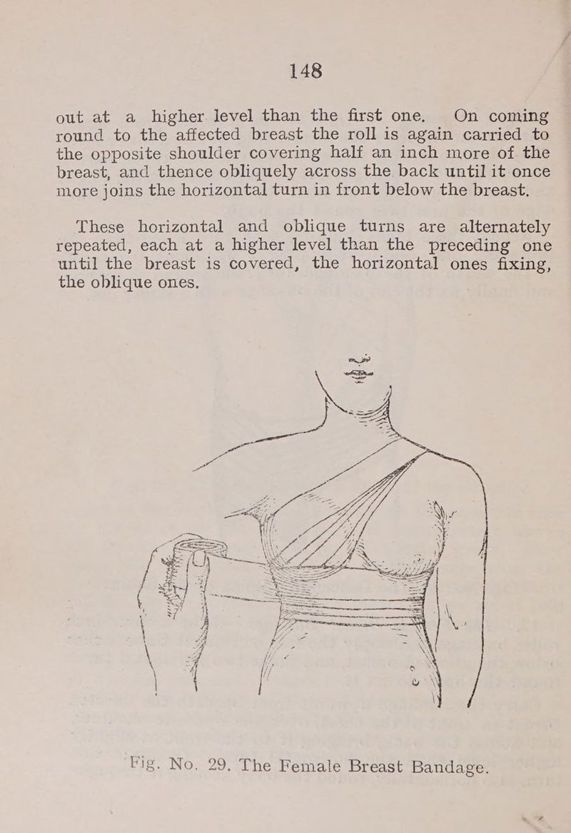 out at a higher level than the first one. On coming round to the affected breast the roll is again carried to the opposite shoulder covering half an inch more of the breast, and thence obliquely across the back until it once more joins the horizontal turn in front below the breast. These horizontal and oblique turns are alternately repeated, each at a higher level than the preceding one until the breast is covered, the horizontal ones fixing, the oblique ones. Vig. No. 29. The Female Breast Bandage.