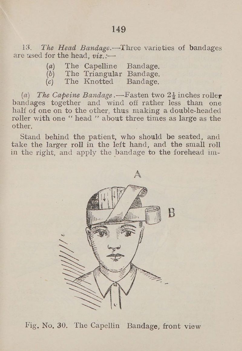 13. The Head Bandage.—Three varieties of bandages are used for the head, viz, :-— (a) The Capelline Bandage. (6) The Triangular Bandage. (c) . The Knotted ~ Bandage. (a) The Capeine Bandage .—lasten two 24 inches roller bandages together and wind off rather less than one half of one on to the other, thus making a double-headed roller with one ‘“‘ head ”’ about three times as large as the other. Stand behind the patient, who should be seated, and take the larger roll in the left hand, and the small roll in the right, and apply the bandage to the forehead im- Pig, No, 30. The Capellin Bandage, front view