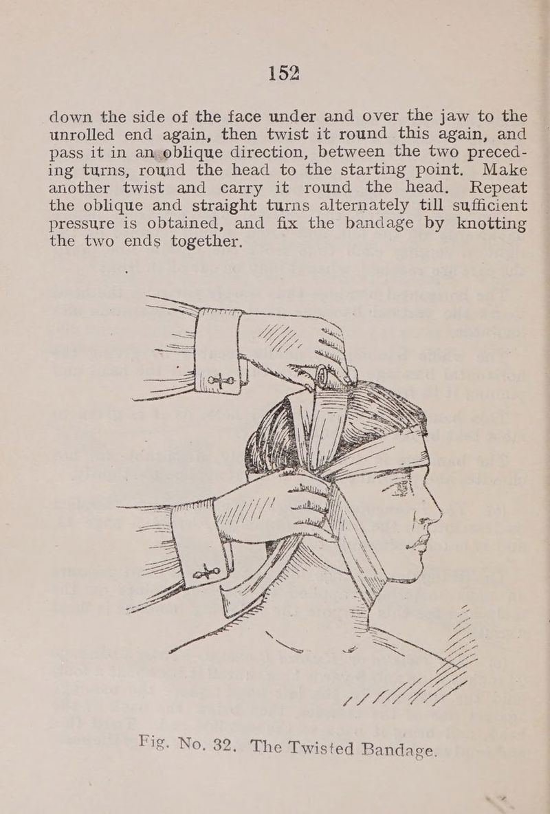down the side of the face under and over the jaw to the unrolled end again, then twist it round this again, and pass it in an-eblique direction, between the two preced- ing turns, round the head to the starting point. Make another twist and carry it round the head. Repeat the oblique and straight turns alternately till sufficient pressure is obtained, and fix the bandage by knotting the two ends together.