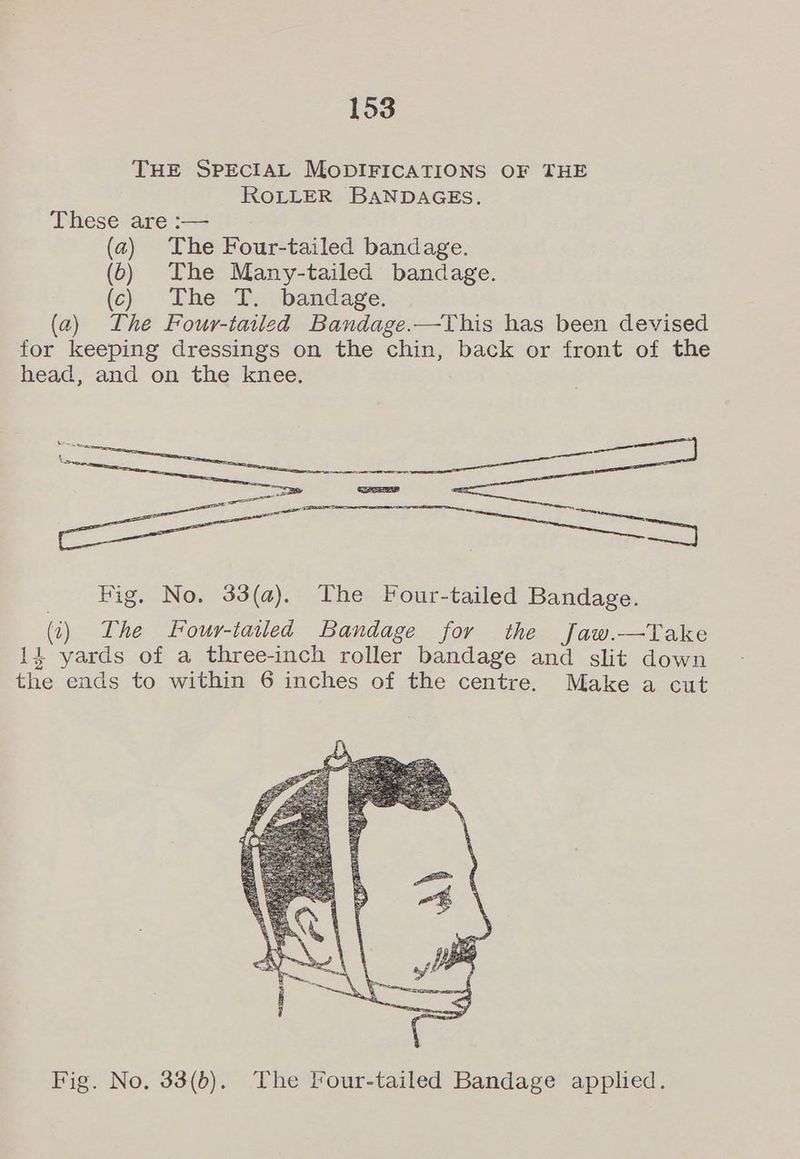 THE SPECIAL MODIFICATIONS OF THE ROLLER BANDAGES. These are :— (a) The Four-tailed bandage. (6) The Many-tailed bandage. (c) The T. bandage. (a) The Four-tailed Bandage.—This has been devised for keeping dressings on the chin, back or front of the head, and on the knee. aa ao Big. No. 33(a). The Four-tailed Bandage. (i) The Four-tailed Bandage for the Jaw.—Take 14 yards of a three-inch roller bandage and slit down the ends to within 6 inches of the centre. Make a cut Fig. No. 33(6). The Four-tailed Bandage applied.