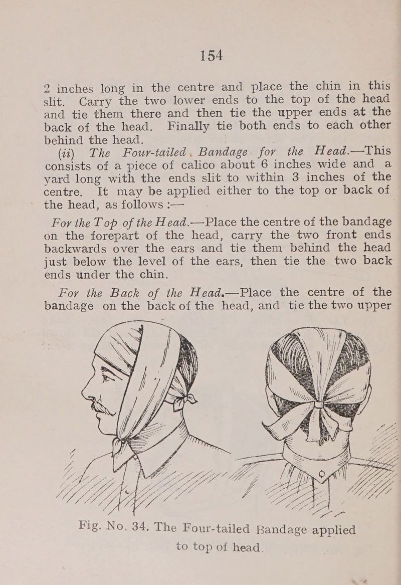 2 inches long in the centre and place the chin in this slit. Carry the two lower ends to the top of the head and tie them there and then tie the upper ends at the back of the head. Finally tie both ends to each other behind the head. (ii) The Four-tailed. Bandage. for the Head.—This consists of a piece of calico about 6 inches wide and a yard long with the ends slit to within 3 inches of the centre. It may be applied either to the top or back of the head, as follows :— For the T op of the Head.—Place the centre of the bandage on the forepart of the head, carry the two front ends backwards over the ears and tie them behind the head just below the level of the ears, then tie the two back ends under the chin. For the Back of the Head.—Place the centre of the bandage on the back of the head, and tie the two upper LZ S Z ‘ “ fe . : Mie ee \ le pg Oe ip Si 4 Sif LL IS AON Bas gp ed Uf a Ve ae. Foe ~ Fig. No, 34. The Four-tailed Bandage applied to top of head.