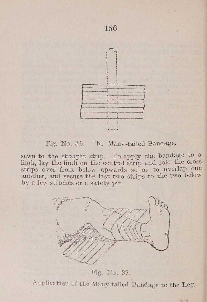 sewn to the straight strip. To apply the bandage to a limb, lay the limb on the central strip and fold the cross strips over from below upwards so as to overlap one another, and secure the last two strips to the two below by a few stitches or a safety pin. > £ ee es Application of the Many-tailed Bandage to the Leg.