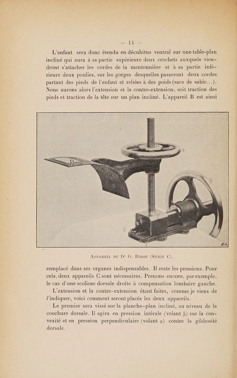 L'enfant sera donc étendu en décubitus ventral sur une table-plan incliné qui aura à sa partie supérieure deux crochets auxquels vien- dront s'attacher les cordes de la mentonnière et à sa partie infé- rieure deux poulies, sur les gorges desquelles passeront deux cordes partant des pieds de l’enfant et reliées à des poids (sacs de sable...). Nous aurons alors l’extension et la contre-extension, soit traction des pieds et traction de la tête sur un plan incliné. L'appareil B est ainsi remplacé dans ses organes indispensables, Il reste les pressions. Pour cela, deux appareils C sont nécessaires. Prenons encore, par exemple, le cas d’une scoliose dorsale droite à compensation lombaire gauche. L'extension et la contre-extension étant faites, comme je viens de l’indiquer, voici comment seront placés les deux appareils. Le premier sera vissé sur la planche-plan incliné, au niveau de la courbure dorsale. Il agira en pression latérale (volant £) sur la con- vexité eten pression perpendiculaire (volant «) contre la gibbosité dorsale. |