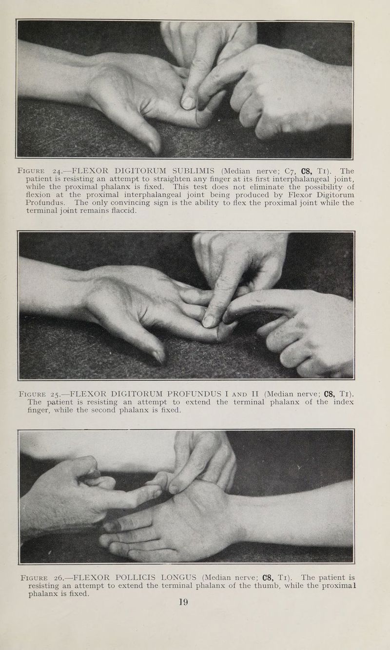 PreGrEe 24. PEE xXOR DIGITOKUM SUBLIMIS (Median nerve; C7, €8, Ir). The patient is resisting an attempt to straighten any finger at its first interphalangeal joint, while the proximal phalanx is fixed. This test does not eliminate the possibility of flexion at the proximal interphalangeal joint being produced by Flexor Digitorum Profundus. The only convincing sign is the ability to flex the proximal joint while the terminal joint remains flaccid. FIGURE 25.—FLEXOR DIGITORUM PROFUNDUS I ann II (Median nerve; (8, T1). The patient is resisting an attempt to extend the terminal phalanx of the index finger, while the second phalanx is fixed. The patient is phalanx is fixed.