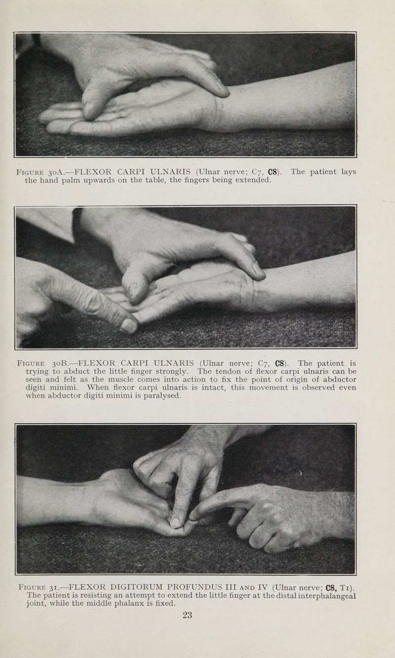 FicgurRE 30A.—FLEXOR CARPI ULNARIS (Ulnar nerve; C7, C8). The patient lays the hand palm upwards on the table, the fingers being extended. FIGURE 305.—PLEXOR CARPI-ULNARIS (Ulnar nerve; C7, C8). The patient is trying to abduct the little finger strongly. The tendon of flexor carpi ulnaris can be seen and felt as the muscle comes into action to fix the point of origin of abductor digiti minimi. When flexor carpi ulnaris is intact, this movement is observed even when abductor digiti minimi is paralysed.