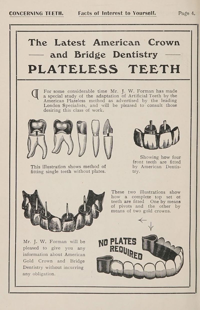 — and Bridge Dentistry -—— desiring this class of work, o Mr. J. W. Forman will be pleased to give you any information about American Gold Crown and_ Bridge Dentistry without incurring any obligation. Showing how four front teeth are fitted by American Dentis- try. These two illustrations show how a complete top set ot teeth are fitted One by means of pivots and the other by means of two gold crowns.