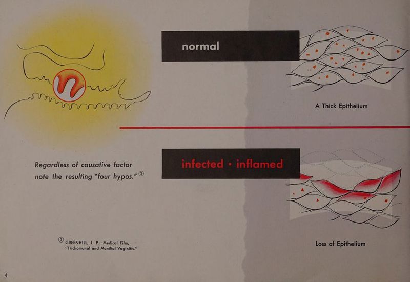 A Thick Epithelium note the resulting “four hypos.” © © GREENHILL, J. P.: Medical Film, Loss of Epithelium “Trichomonal and Monilial Vaginitis.”