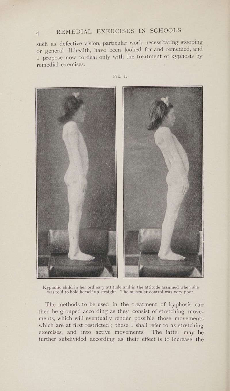such as defective vision, particular work necessitating stooping or general ill-health, have been looked for and remedied, and I propose now to deal only with the treatment of kyphosis by remedial exercises. BiGeels The methods to be used in the treatment of kyphosis can: then be grouped according as they consist of stretching move- ments, which will eventually render possible those movements. which are at first restricted ; these I shall refer to as stretching exercises, and into active movements. The latter may be further subdivided according as their effect is to increase the