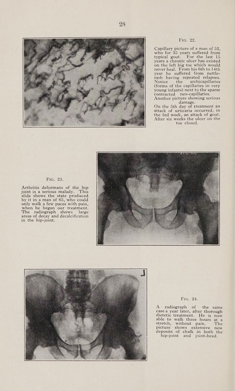 Ke, P83. Arthritis deformans of the hip joint is a serious malady. This slide shows the state produced by it in a man of 65, who could only walk a few paces with pain, when he began our treatment. The radiograph shows large areas of decay and decalcification in the hip-joint. PIG; 22. Capillary picture of a man of 52, who for 35 years suffered from typical gout. For the last 15 years a chronic ulcer has existed on the left big toe which would never heal. From his 6th to 14th year he suffered from nettle- rash having repeated relapses. Notice the archicapillaries (forms of the capillaries in very young infants) next to the sparse contracted neo-capillaries. Another picture showing serious damage. On the 5th day of treatment an attack of urticaria occurred, in the 3rd week, an attack of gout. After six weeks the ulcer on the toe closed. RiGee. A radiograph of the same case a year later, after thorough dietetic treatment. He is now able to walk three hours at a stretch, without pain. The picture shows extensive new deposits of chalk in both the hip-joint and joint-head.